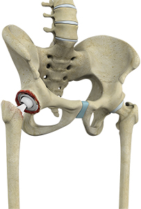 Revision Hip Replacement